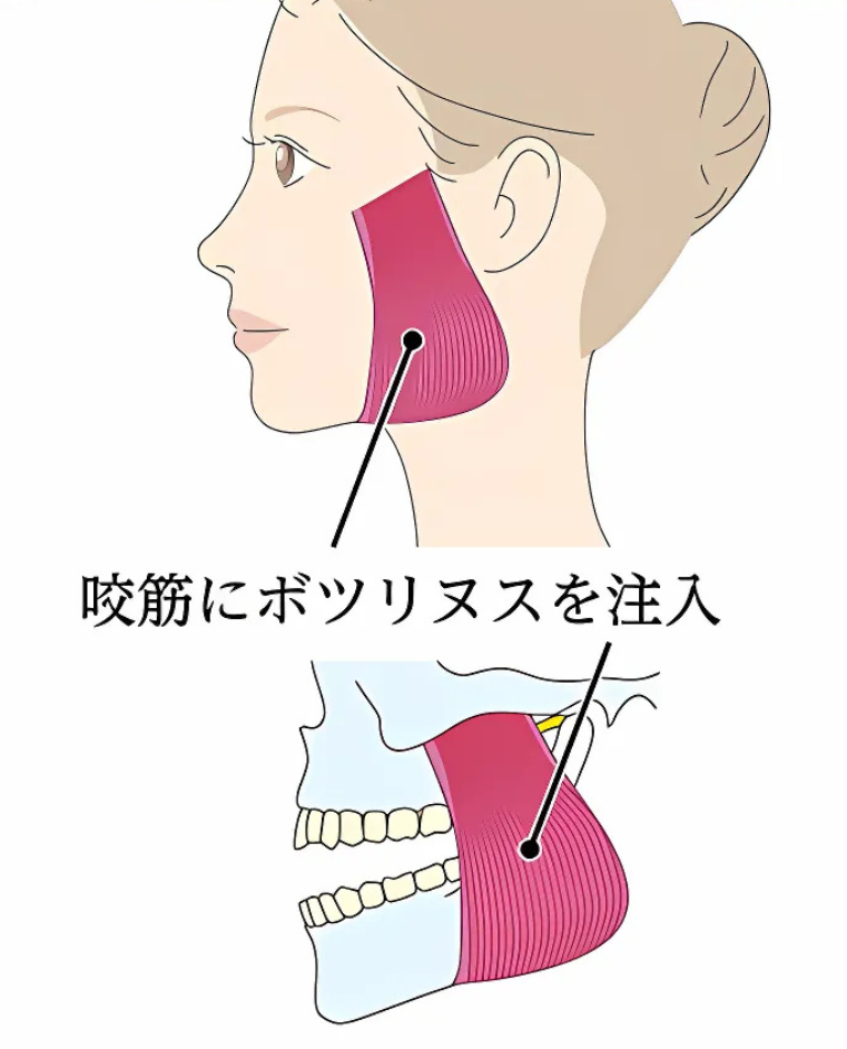 咬筋ボツリヌス治療の仕組み|MAEDA DENTAL