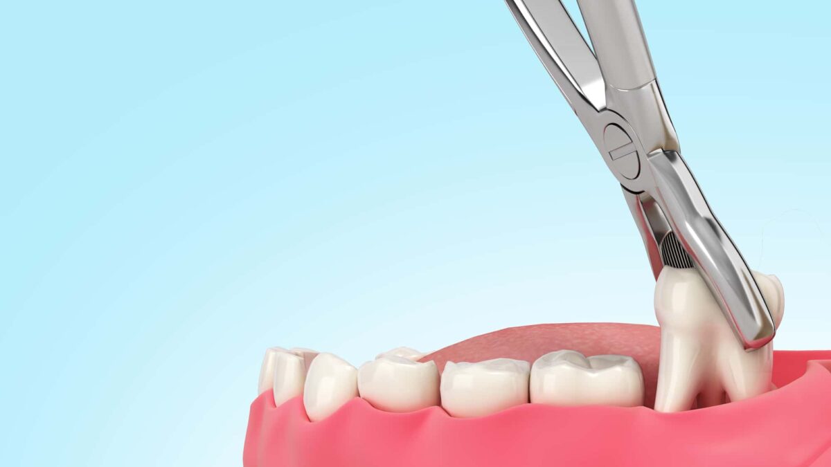 wisdom-tooth-extraction-