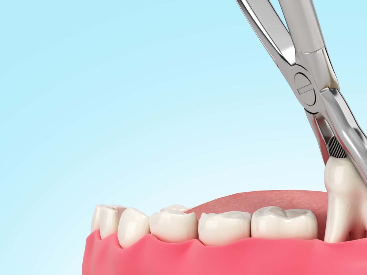 wisdom-tooth-extraction-