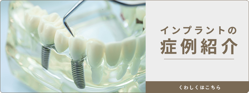 MAEDA DENTAL CLINIC　インプラントの症例紹介