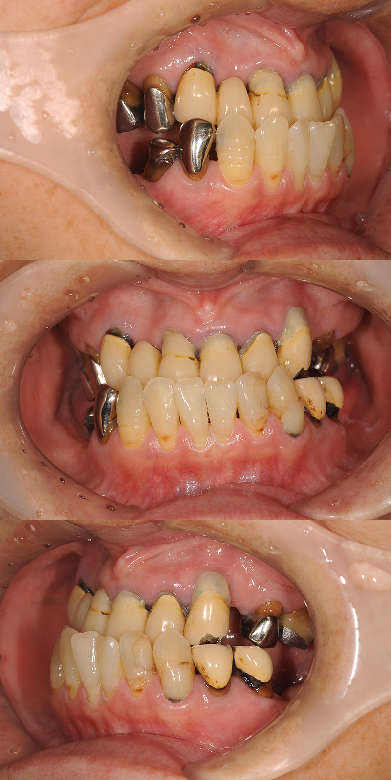 case_implant-01b