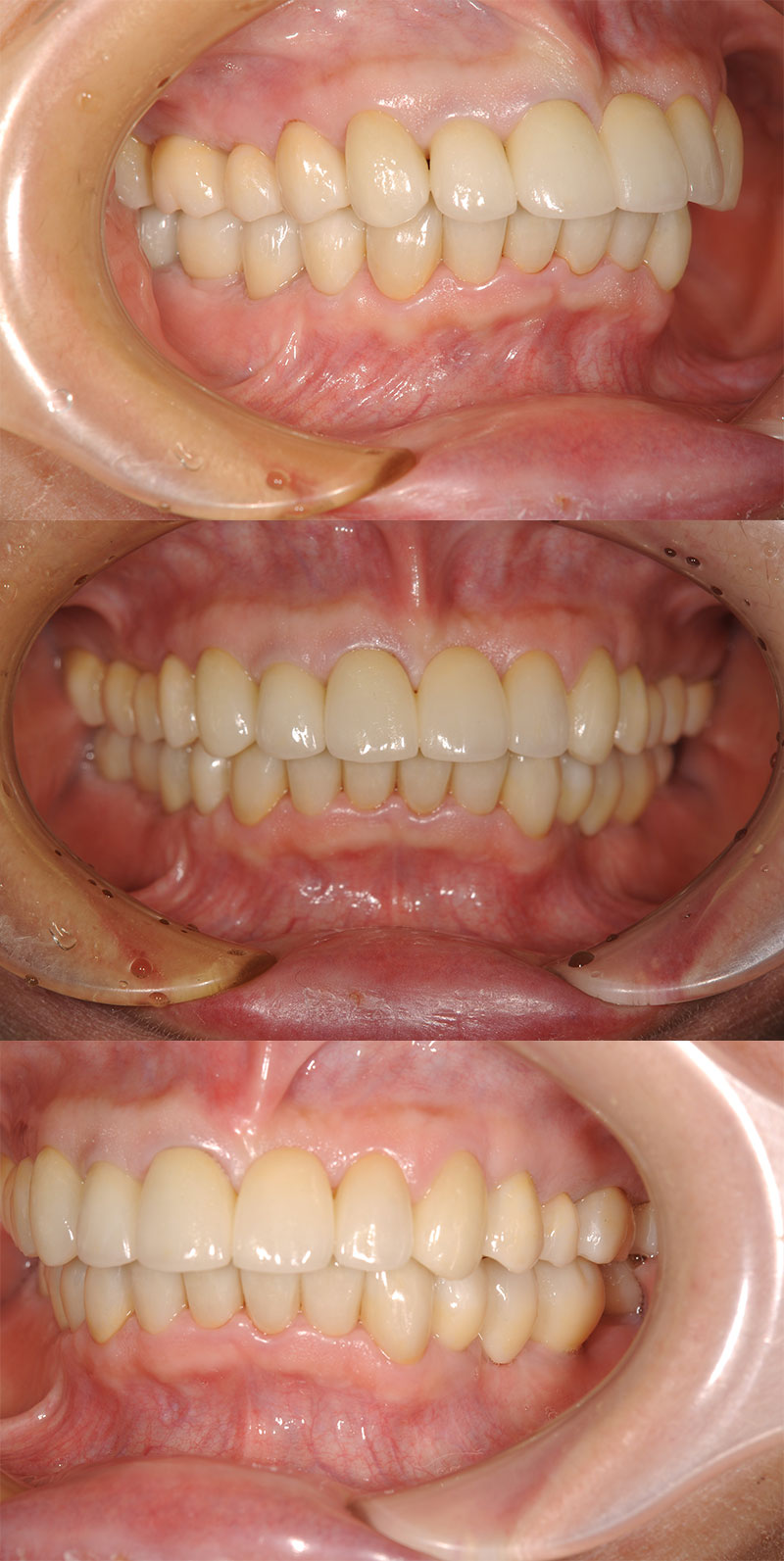 case_implant-02a