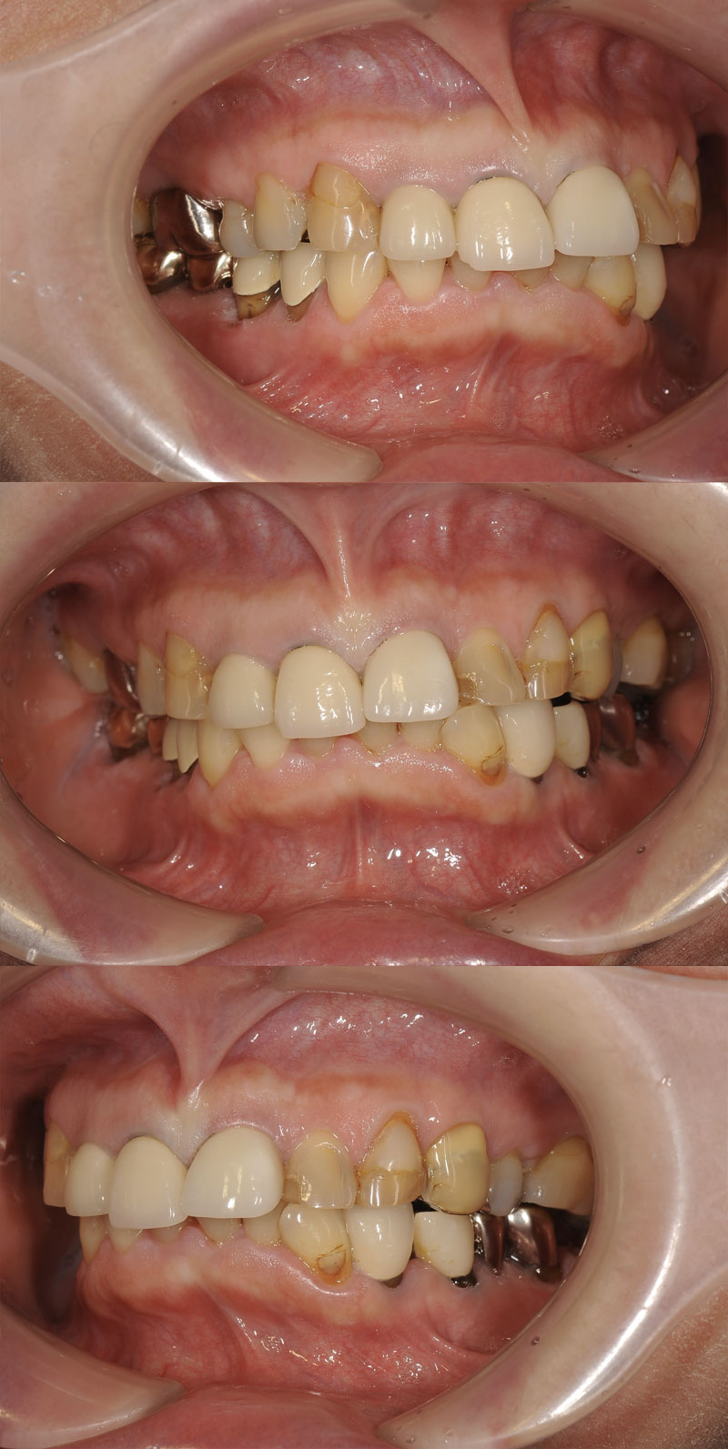 case_implant-02b