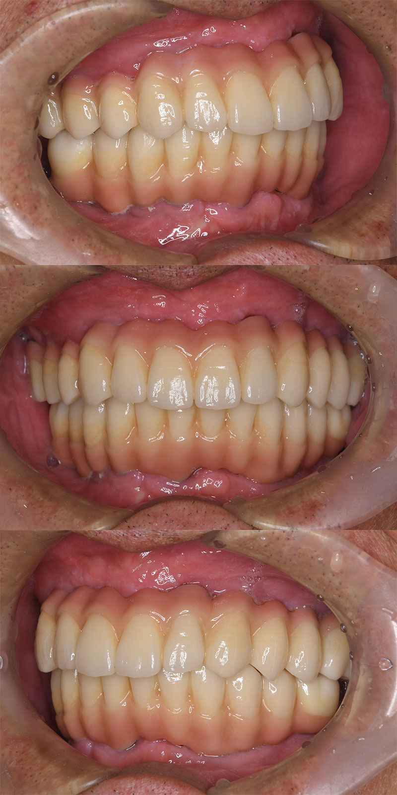 case_implant-03a