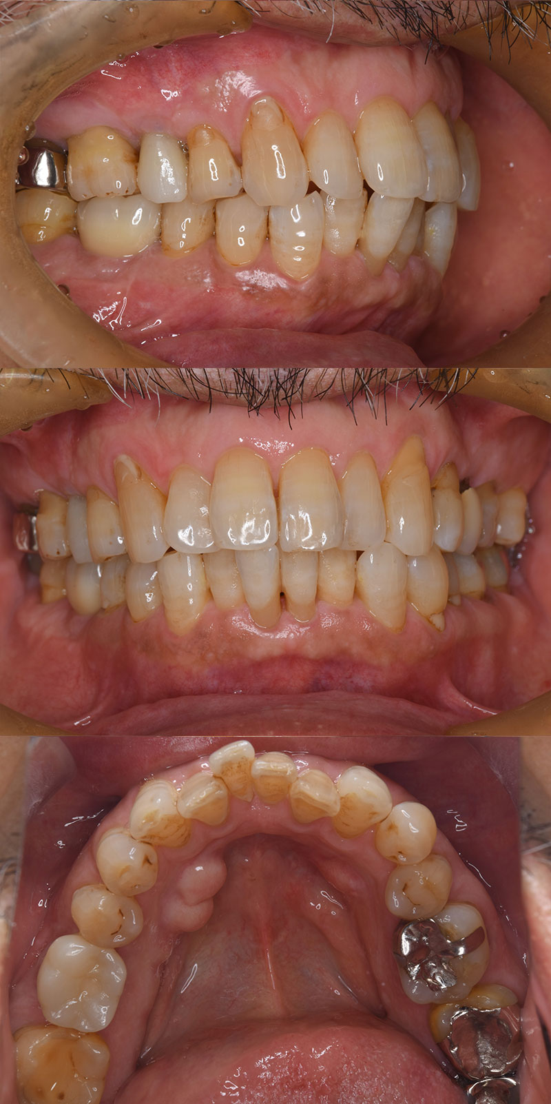 case_implant-05a