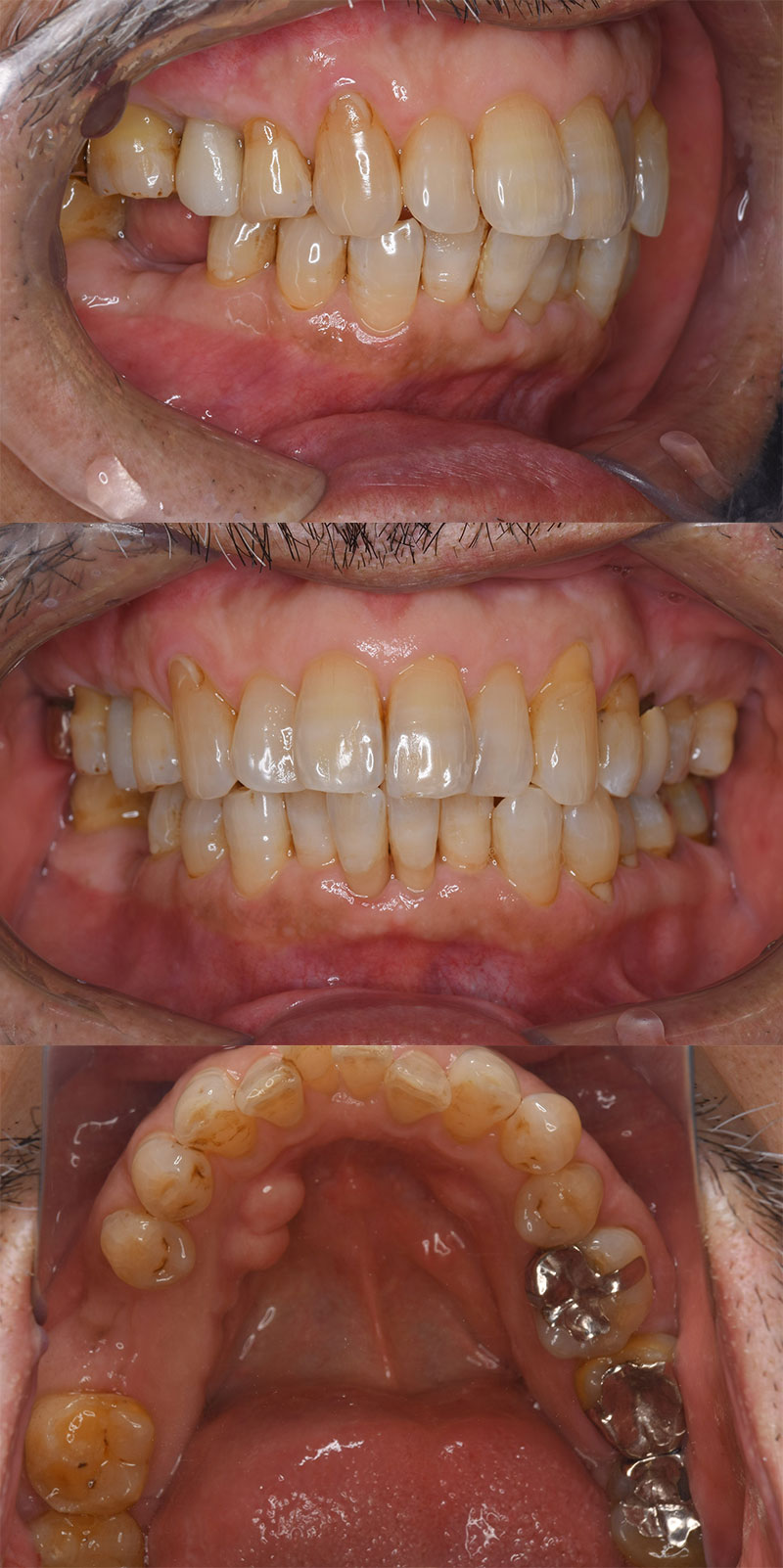 case_implant-05b