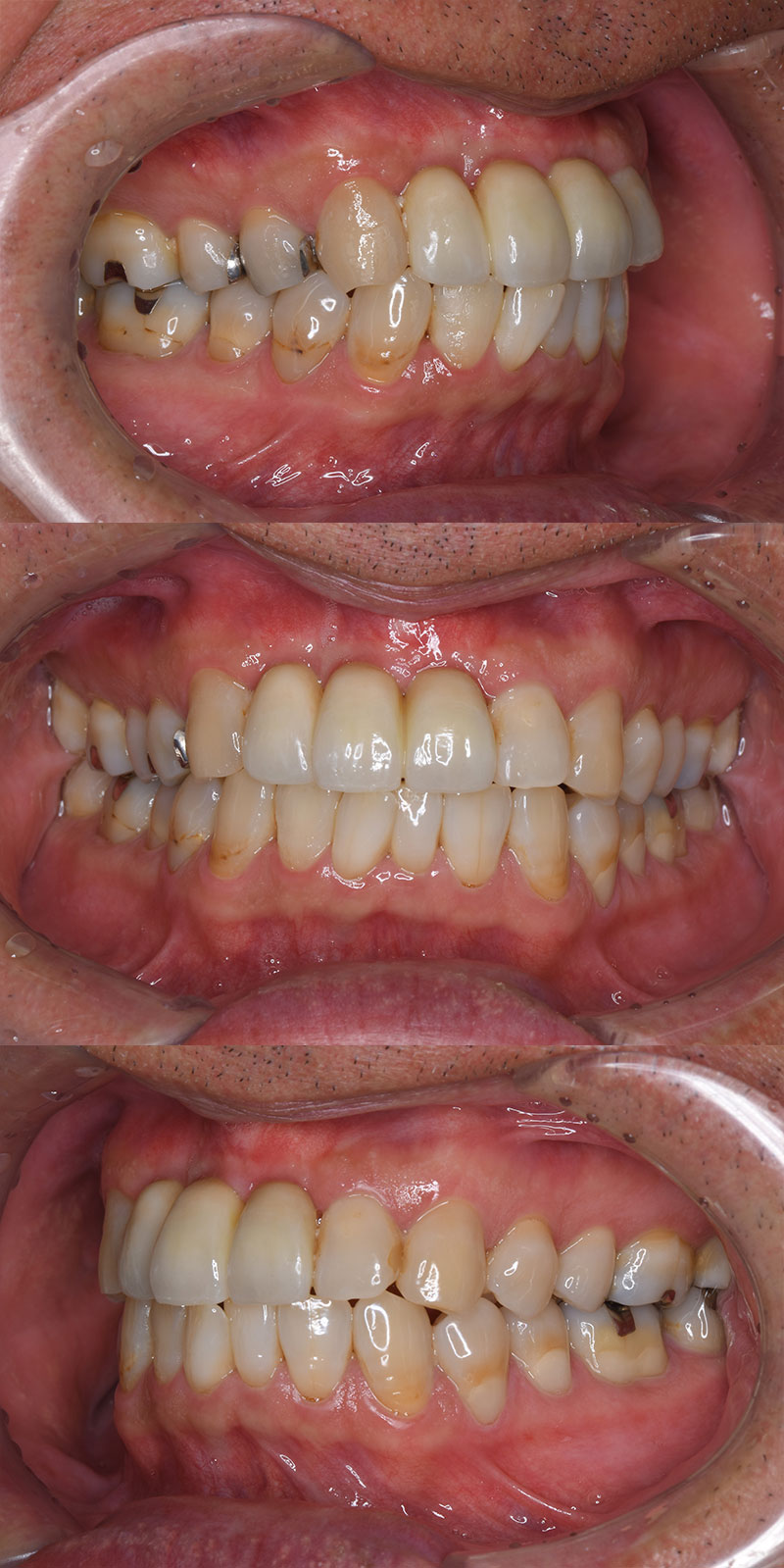 case_implant-06a