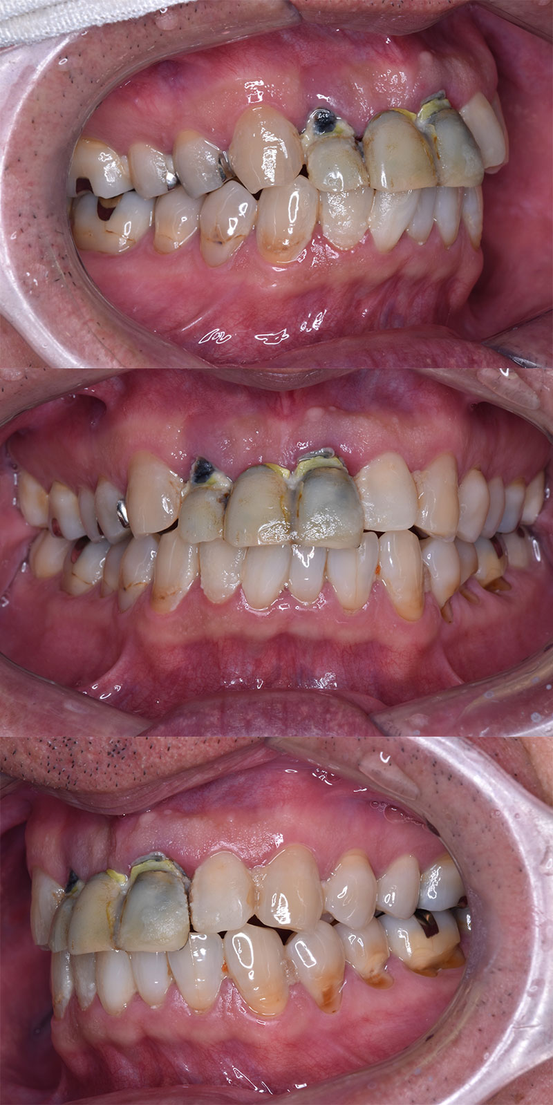 case_implant-06b