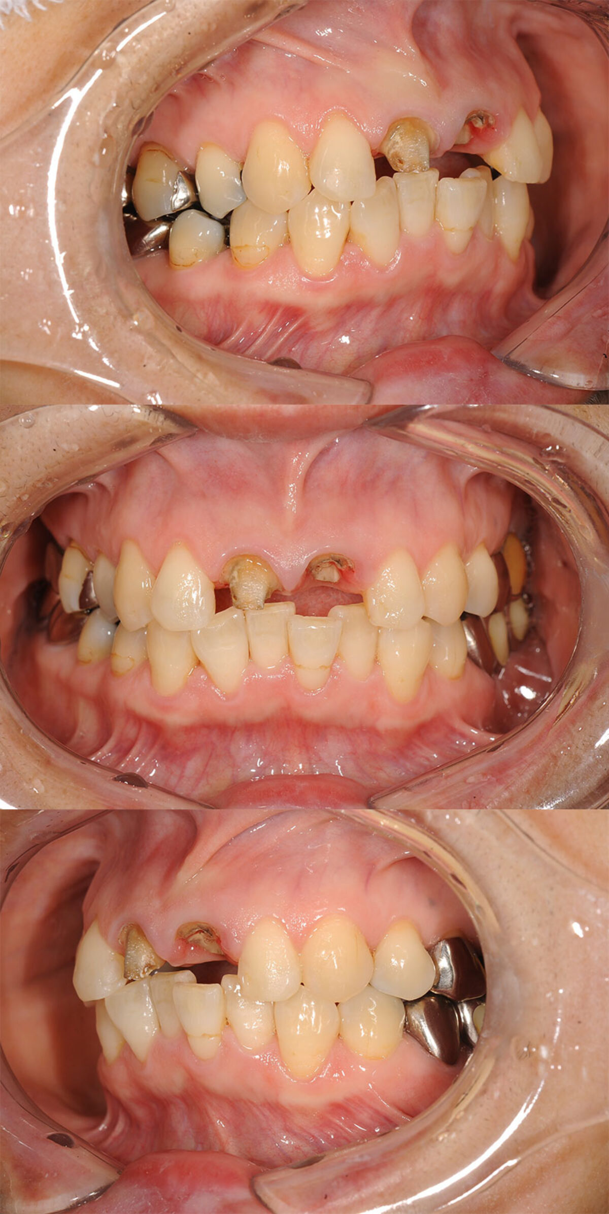 50代女性前歯インプラントケース | MAEDA DENTAL CLINIC