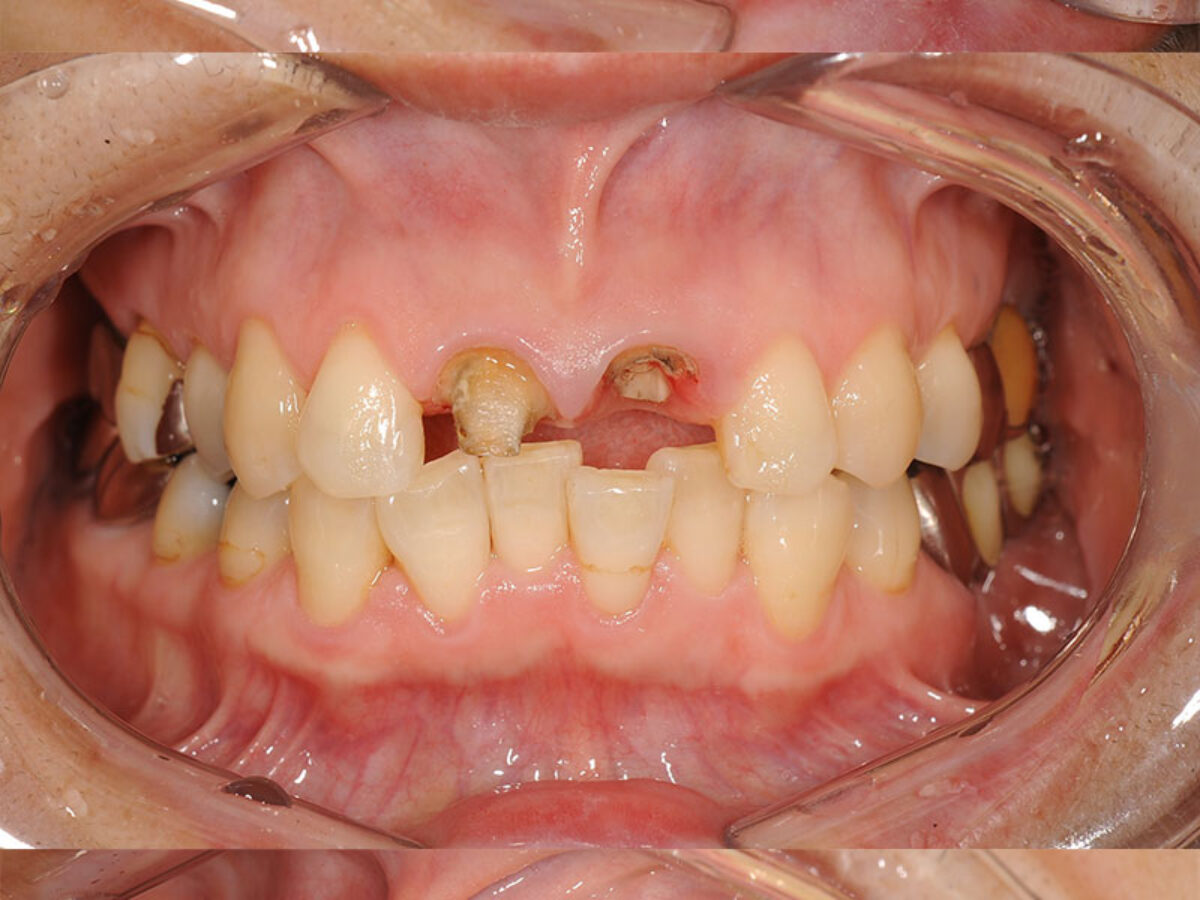 50代女性前歯インプラントケース | MAEDA DENTAL CLINIC