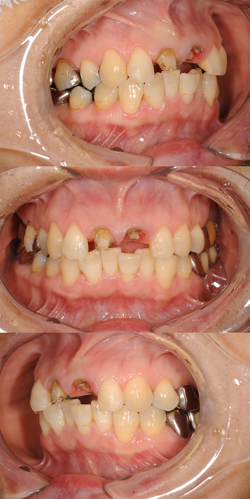 case_implant-07b