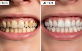 ホワイトニングの前後のイメージ