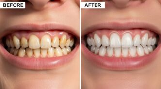 ホワイトニングの前後のイメージ