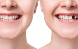 歯のブリッジ治療の前後のイメージ