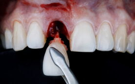 インプラント治療を行うために抜歯をしているイメージ