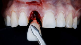 インプラント治療を行うために抜歯をしているイメージ