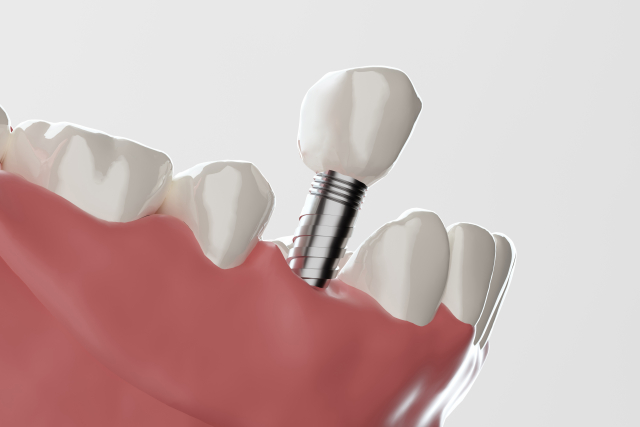 インプラント埋入イメージ