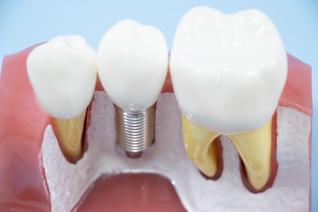 インプラントについて説明する歯科医