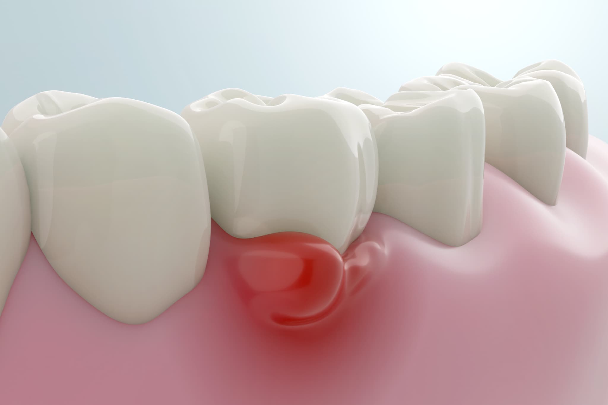 口臭の原因である歯周病の歯茎
