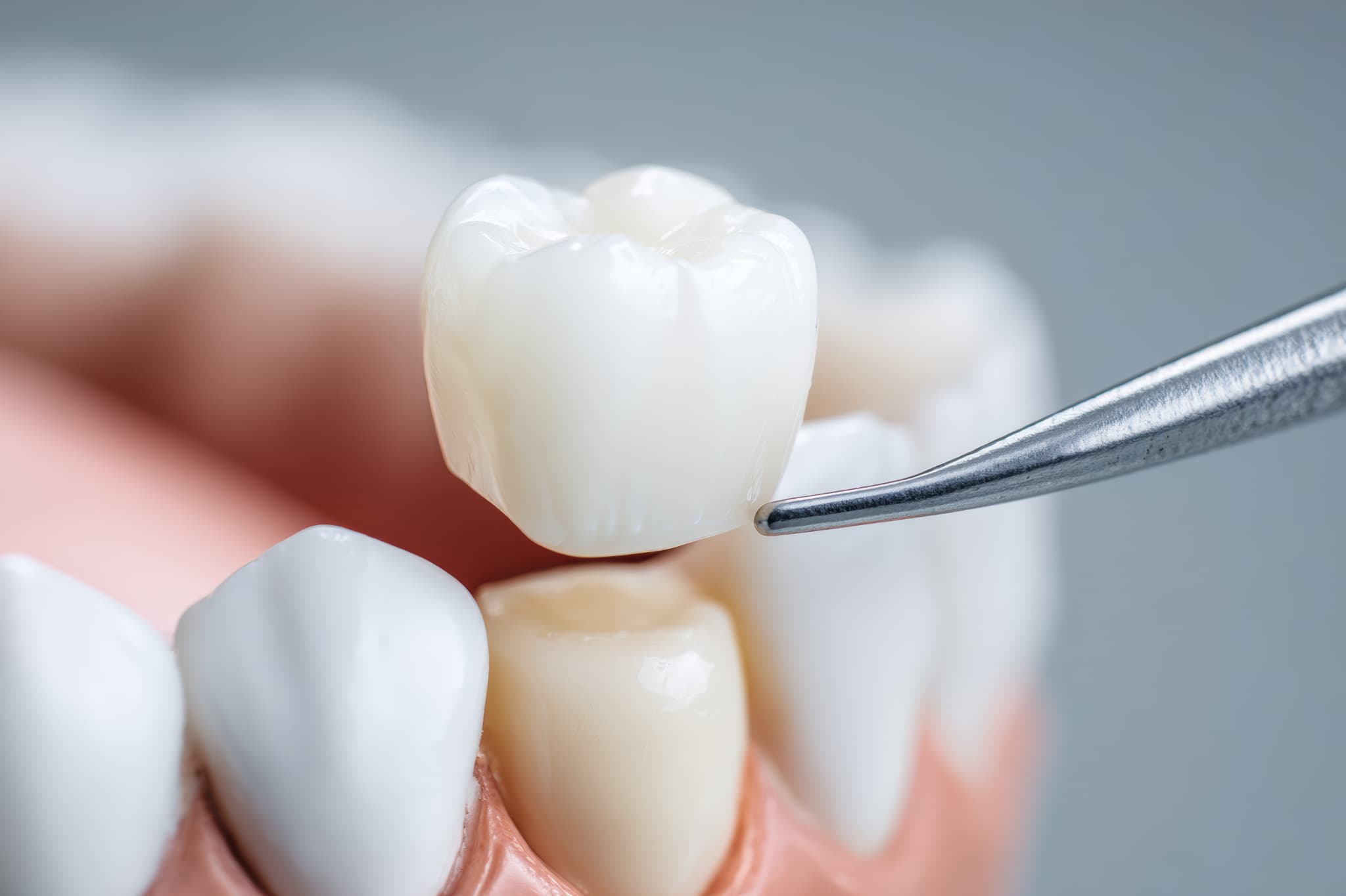 セラミックでできた被せ物