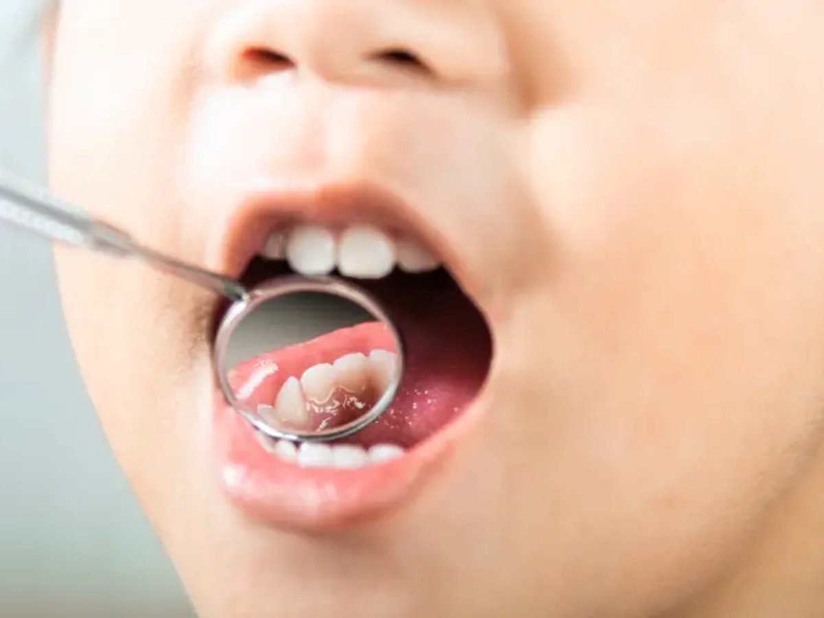 お子さまの口腔内をミラーで確認している様子