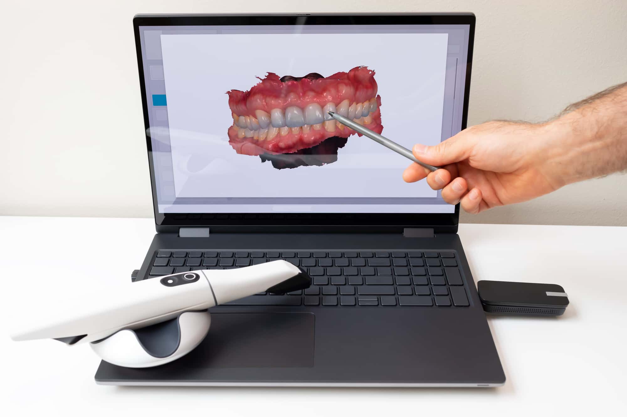 スキャンした歯型をコンピュータで確認するイメージ